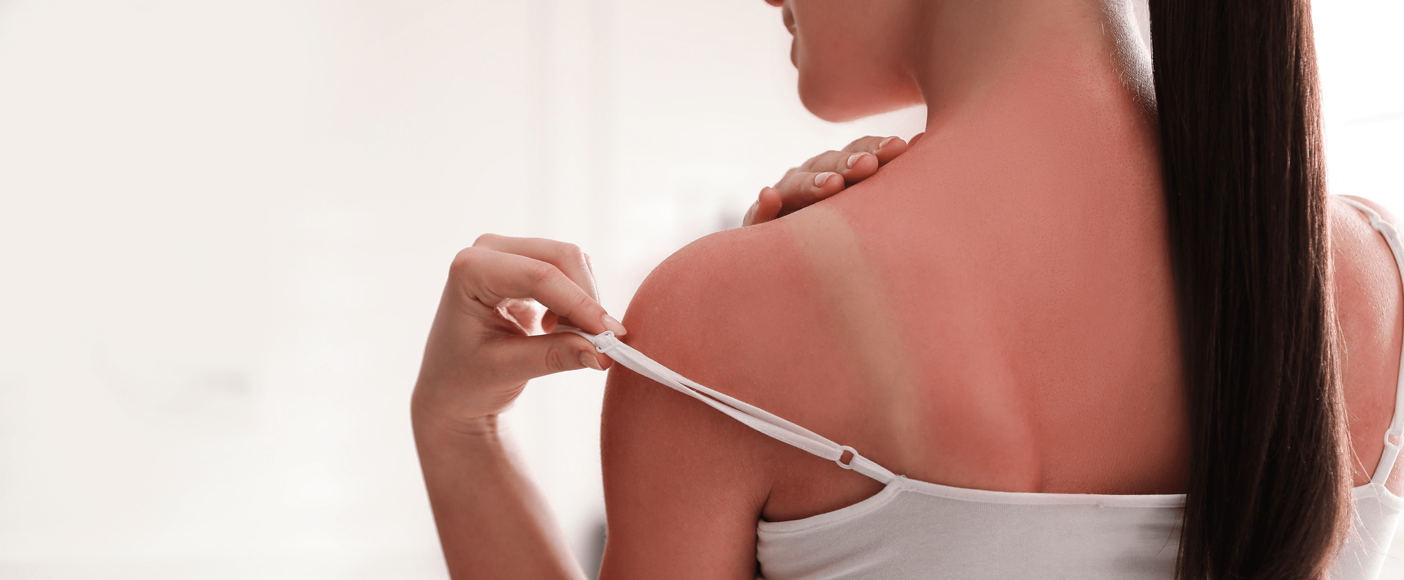 sunburn-treatment-how-long-does-sunburn-last-eucerin-uk